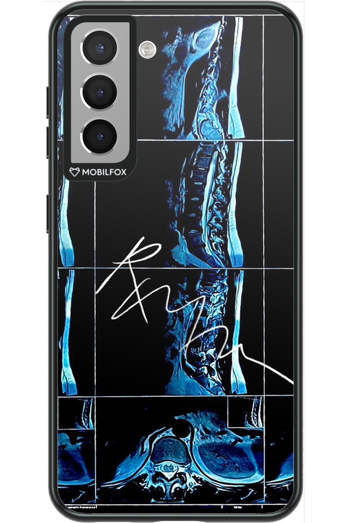 RMN Scolioza 2.0 - Samsung Galaxy S21