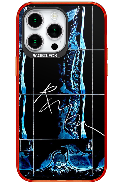 RMN Scolioza 2.0 - Apple iPhone 15 Pro Max