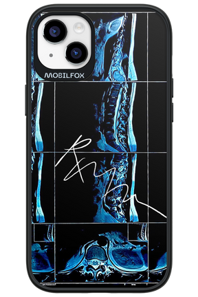 RMN Scolioza 2.0 - Apple iPhone 14 Plus