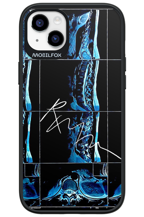 RMN Scolioza 2.0 - Apple iPhone 14 Plus