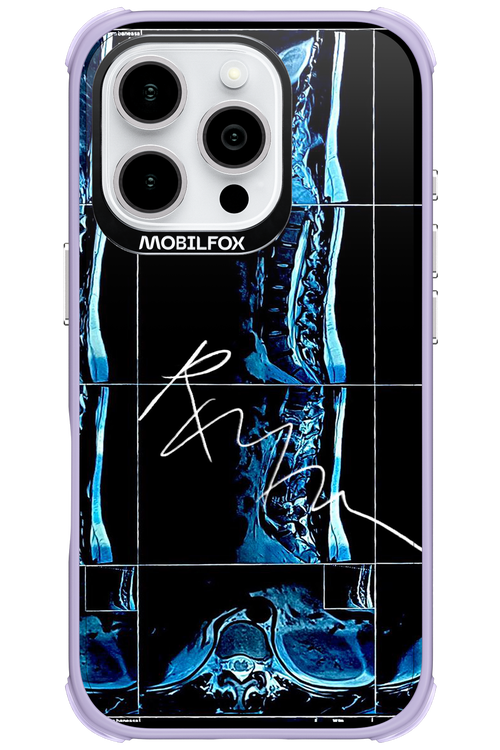RMN Scolioza 2.0 - Apple iPhone 16 Pro