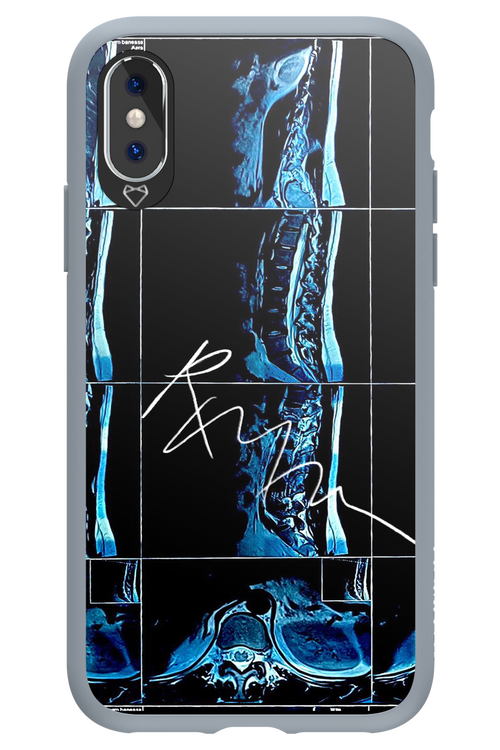RMN Scolioza 2.0 - Apple iPhone XS