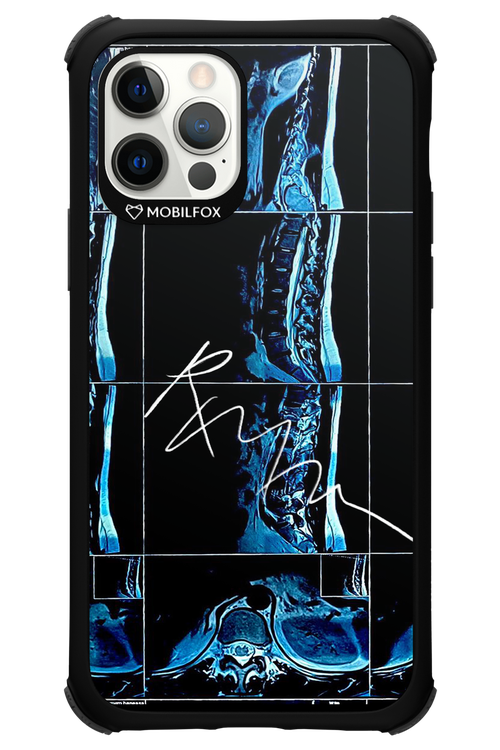 RMN Scolioza 2.0 - Apple iPhone 12 Pro